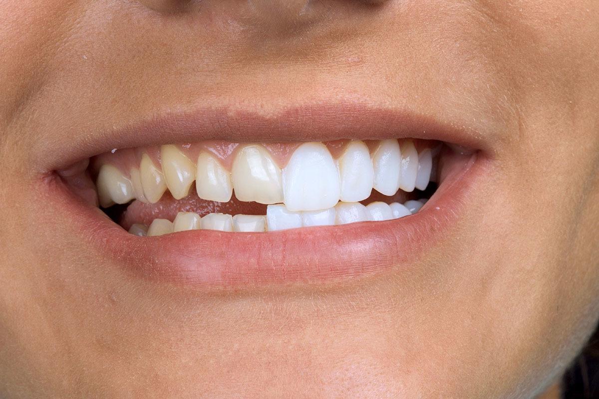 Преимущества и недостатки виниров для зубов: все, что вам нужно знать
